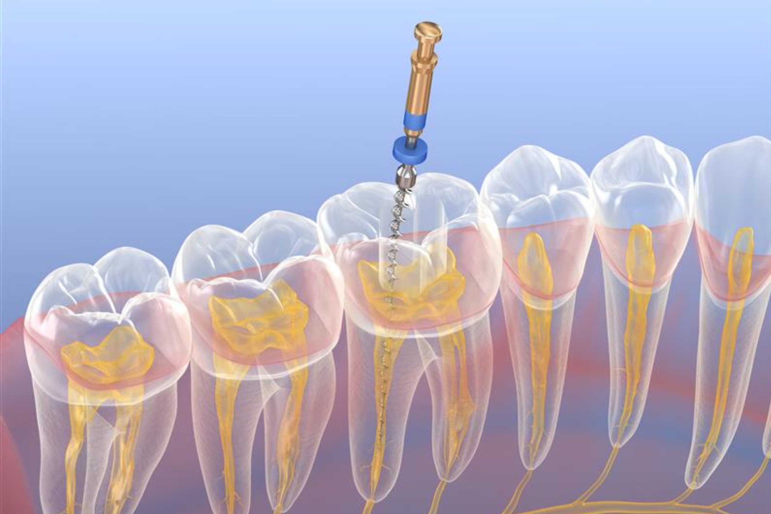 Root canal treatment